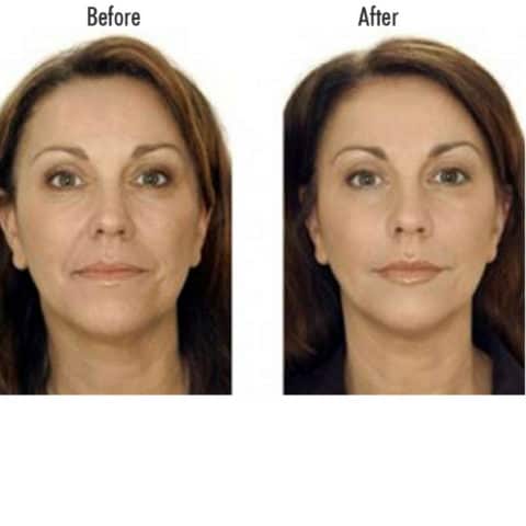 Access facelift схема